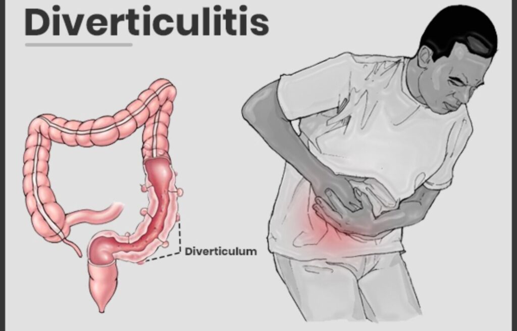 Diverticulitis Treatments and Management