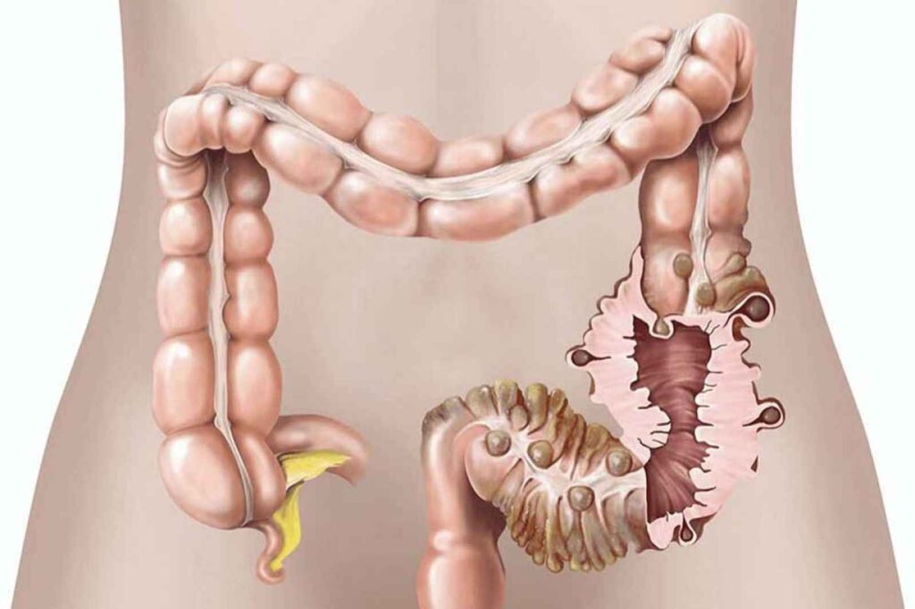 Odor: The Distinctive Diverticulitis Poop Smell