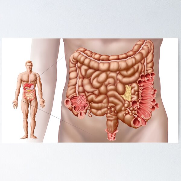 Appearance and Shape of Diverticulitis Poop