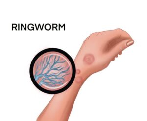 What Is Ringworm and How Does It Typically Present?
