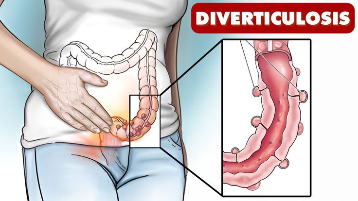 What Does Poop Look Like With Diverticulitis: Guide & Symptoms