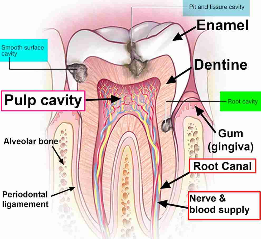 What Does a Cavity Look Like? Guide to Spotting Tooth Decay