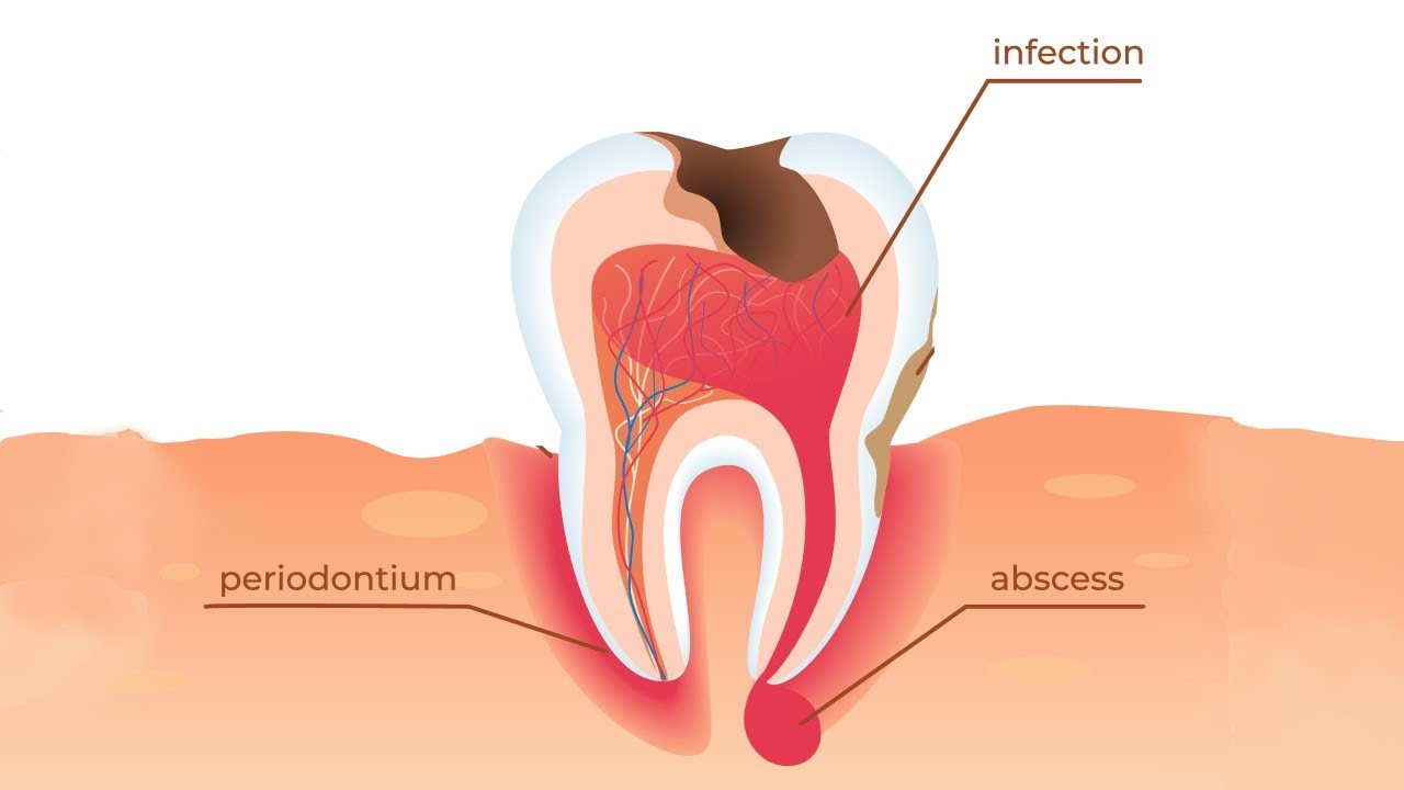 How a Tooth Infection Spreads
