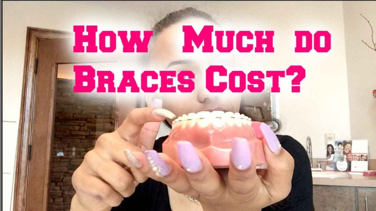 How Much Do Braces Cost in the USA? A Complete 2026 Price Guide