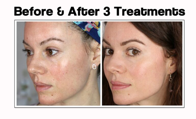 Microneedling Before and After: USA Transformations That Wow