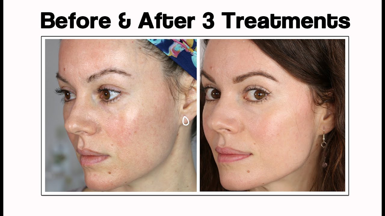 Microneedling Before and After: USA Transformations That Wow